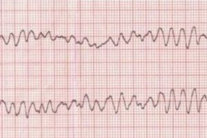ECG_600x400